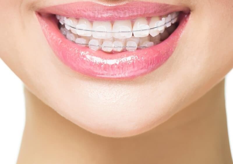 7 consejos para lavar los dientes con brackets Ortodoncia