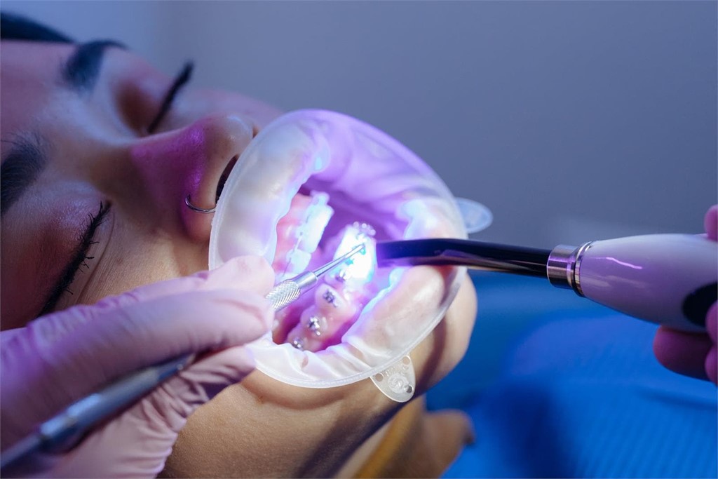 ¿Cada cuánto tiempo debemos acudir al dentista si llevamos brackets?