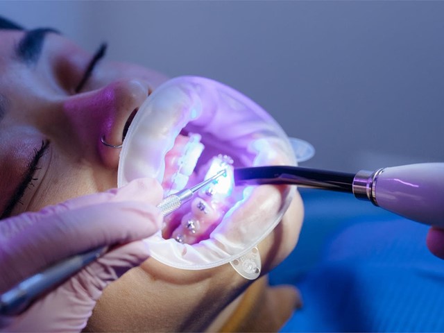 ¿Cada cuánto tiempo debemos acudir al dentista si llevamos brackets?