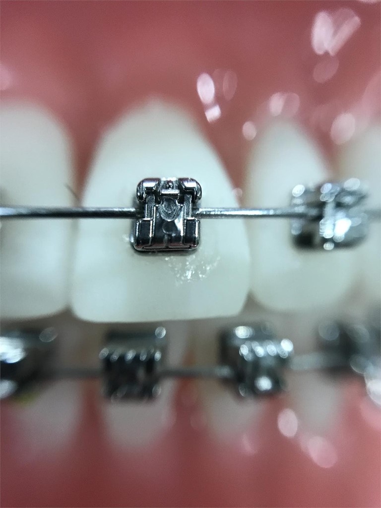 ¿Cómo cuidar la higiene dental cuando usas brackets?