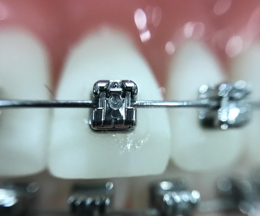 ¿Cómo prepararse correctamente un tratamiento de ortodoncia?