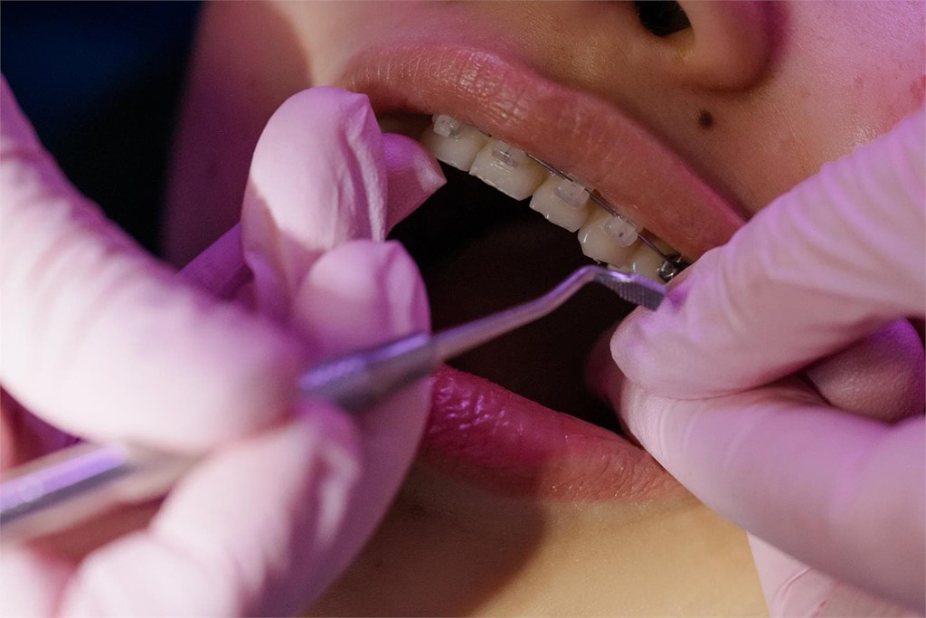 Consejos para limpiar nuestros dientes con brackets