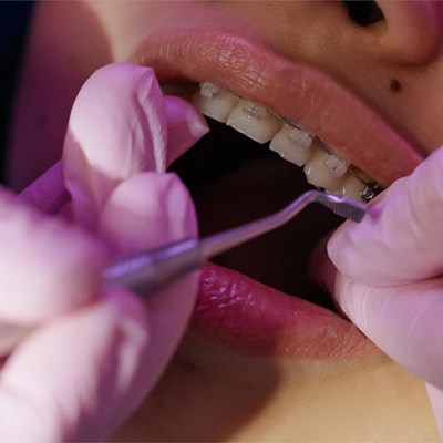Consejos para limpiar nuestros dientes con brackets