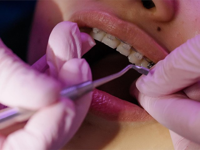 Consejos para limpiar nuestros dientes con brackets