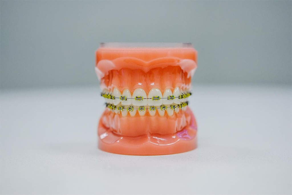 ¿Cuál es la mejor manera de limpiar los brackets?