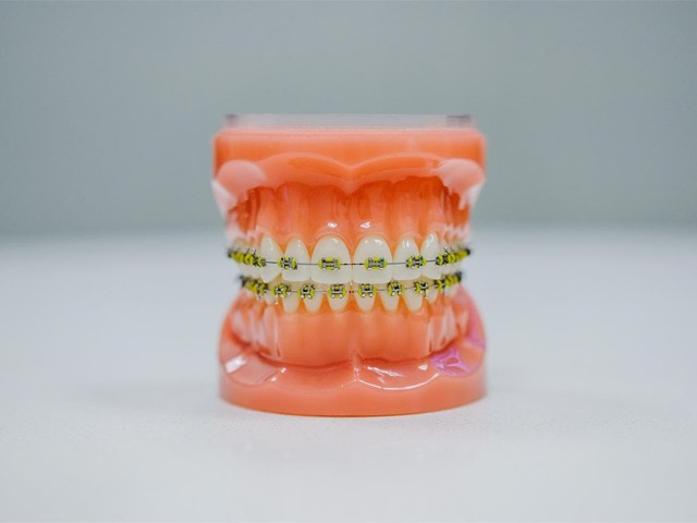 ¿Cuál es la mejor manera de limpiar los brackets?