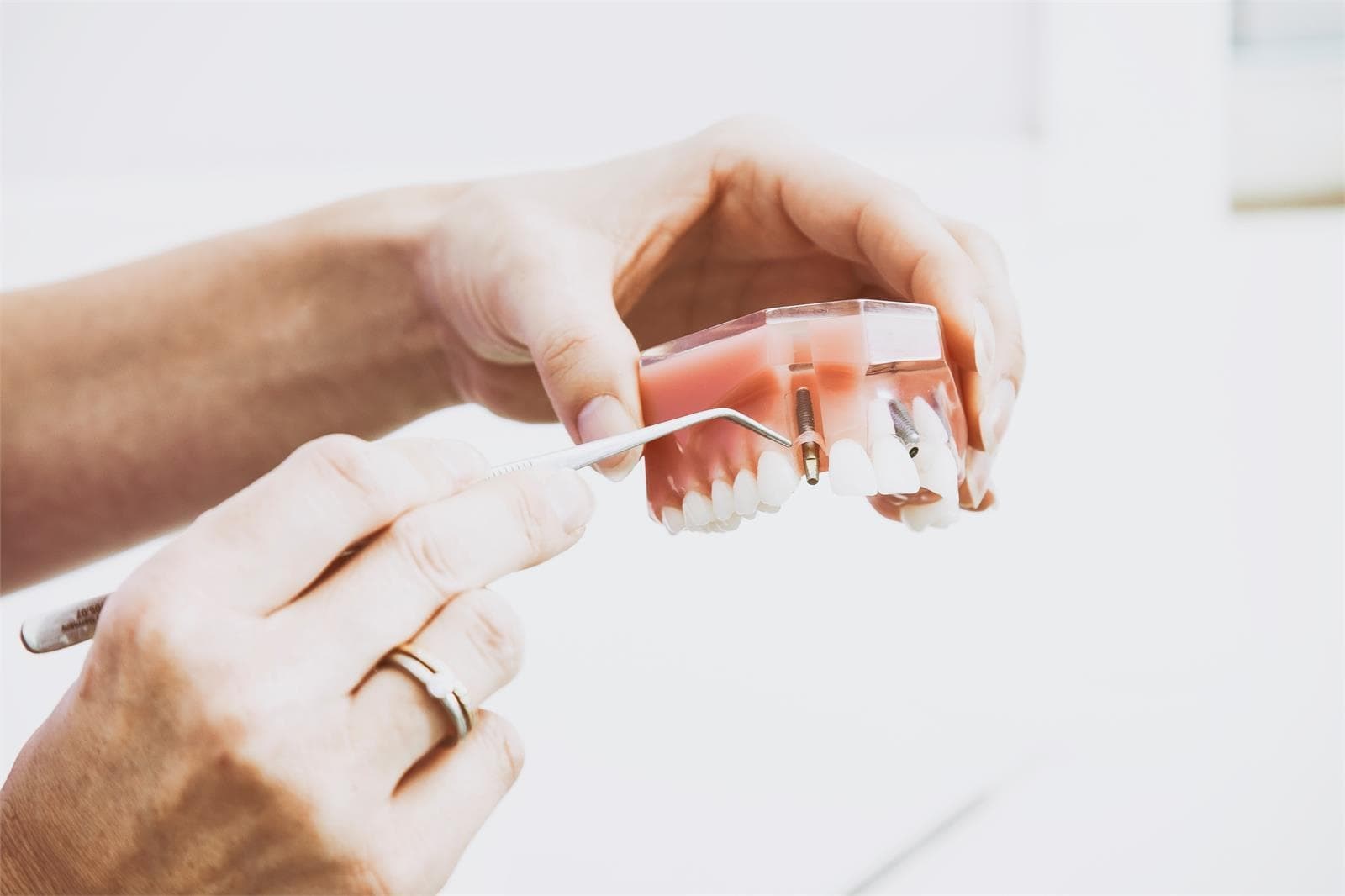 Cuidados de la ortodoncia durante y después del tratamientos - Imagen 1