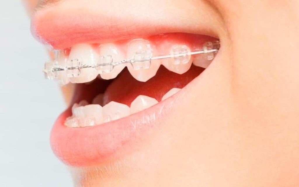 Damon System: Características de este tipo de ortodoncia
