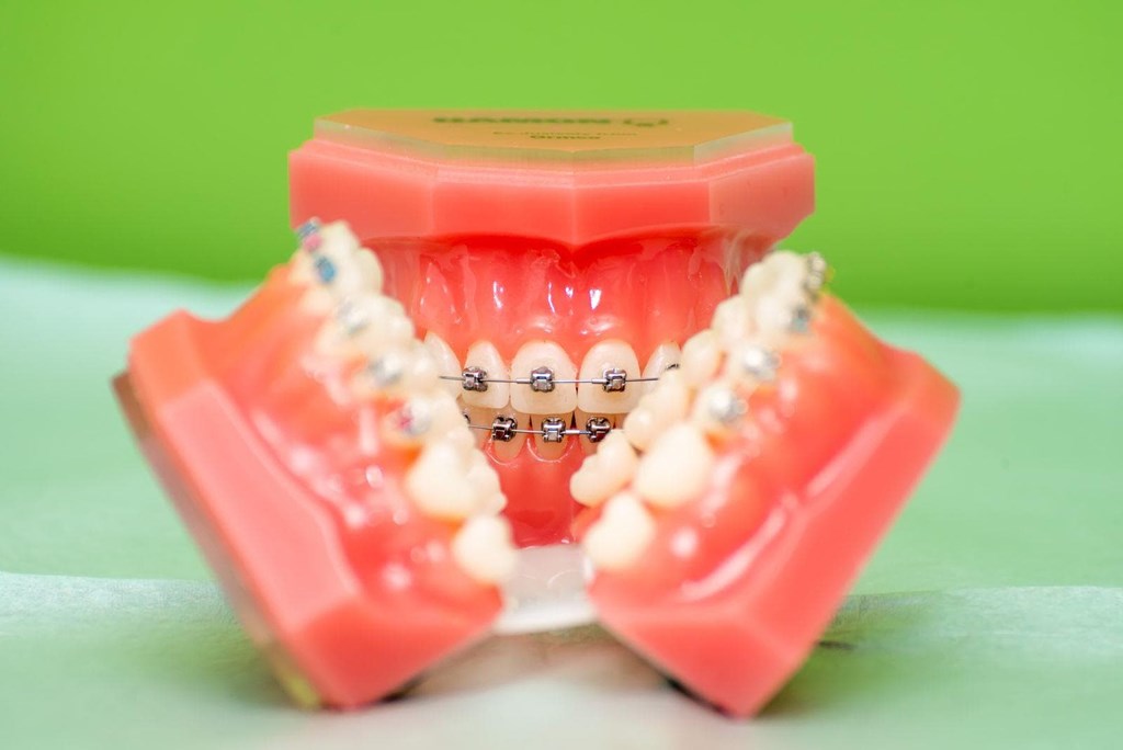 ¿El tratamiento con brackets autoligados es más rápido que con brackets tradicionales?
