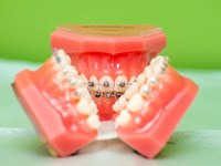 ¿El tratamiento con brackets autoligados es más rápido que con brackets tradicionales?