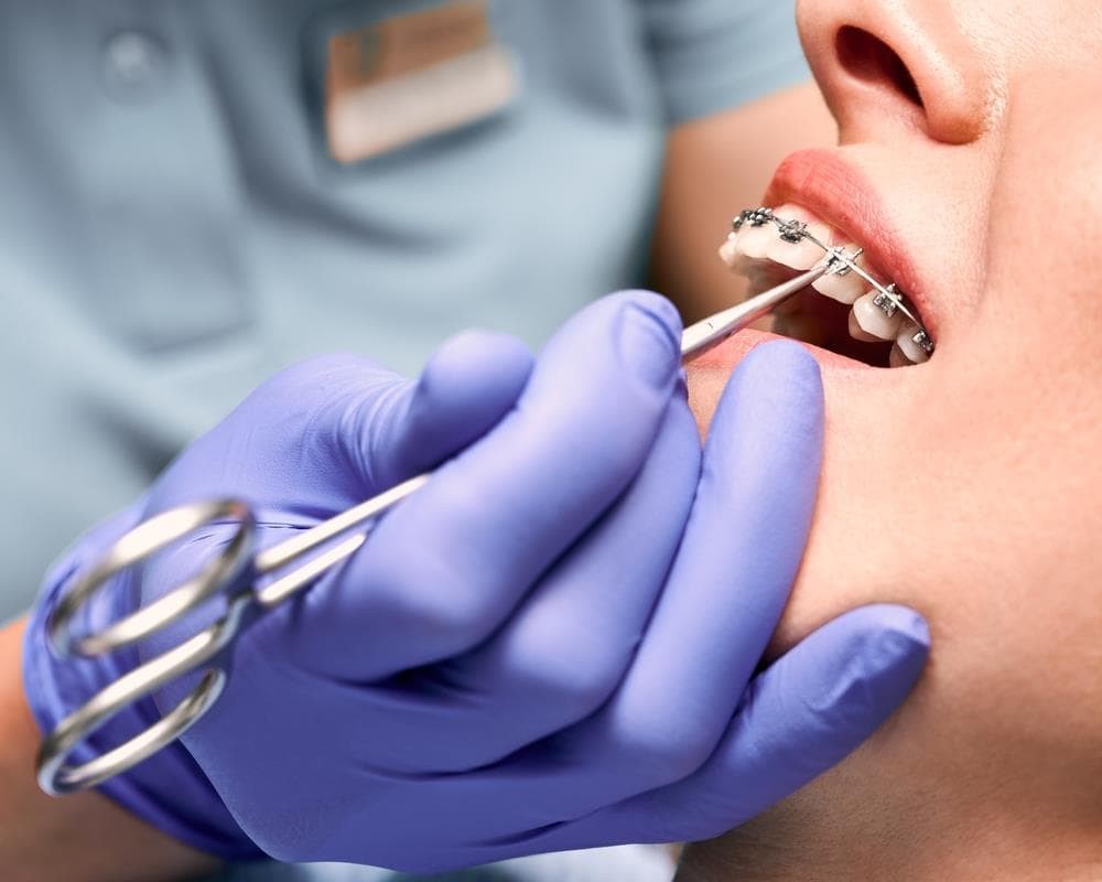 ¿Es recomendable quitar las muelas del juicio antes de la ortodoncia?