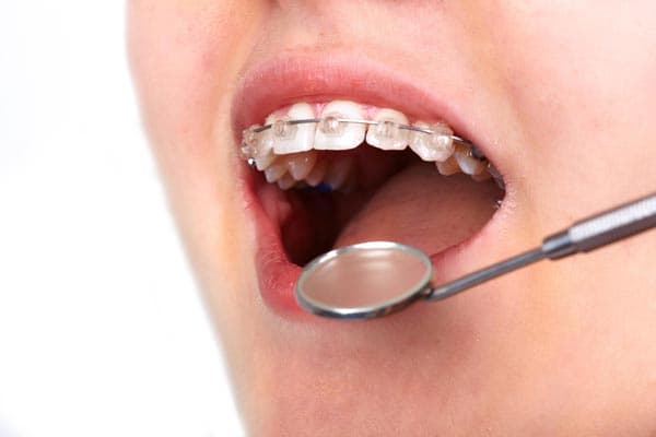 Brackets de autoligado