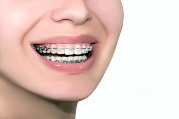 Brackets estéticos