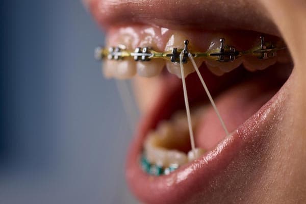 Brackets tradicionales