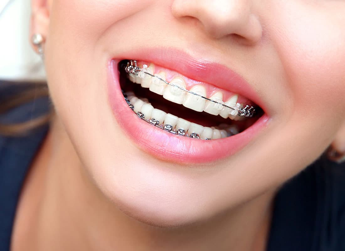 Qué son los brackets estéticos