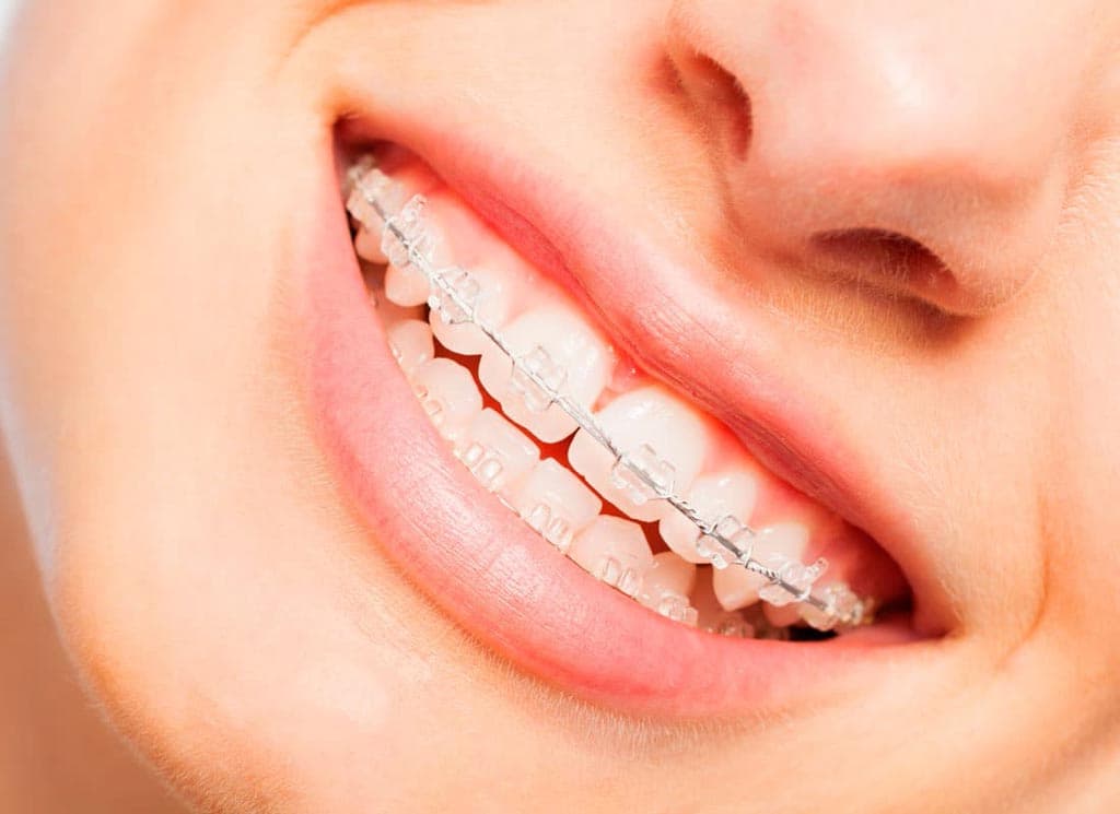 Cuidados durante el tratamiento de ortodoncia