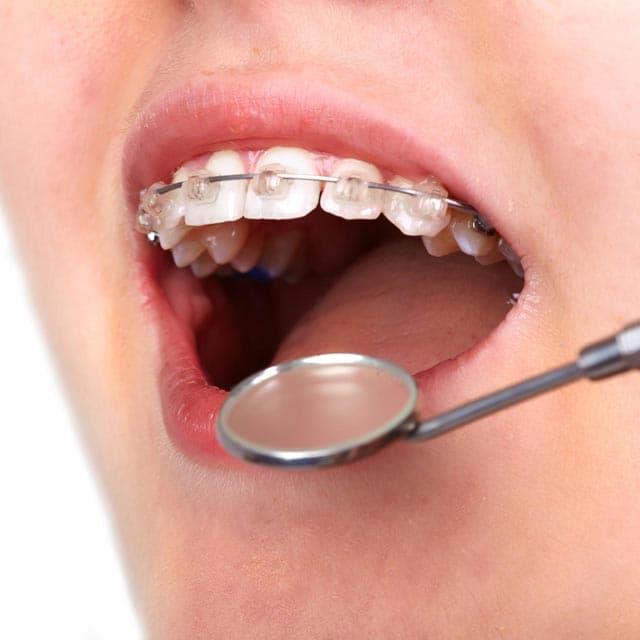 Tratamiento con brackets de autoligado en Vigo