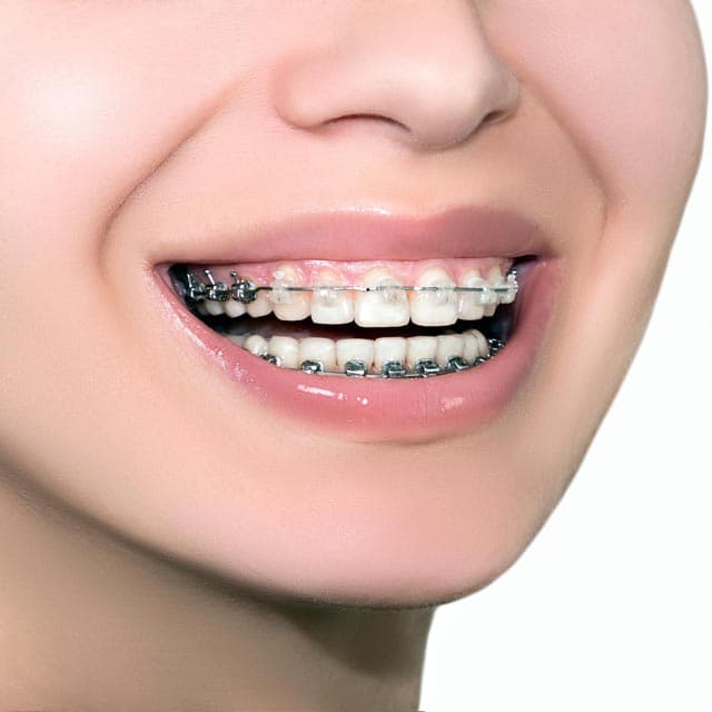 Tratamiento de brackets estéticos en Vigo