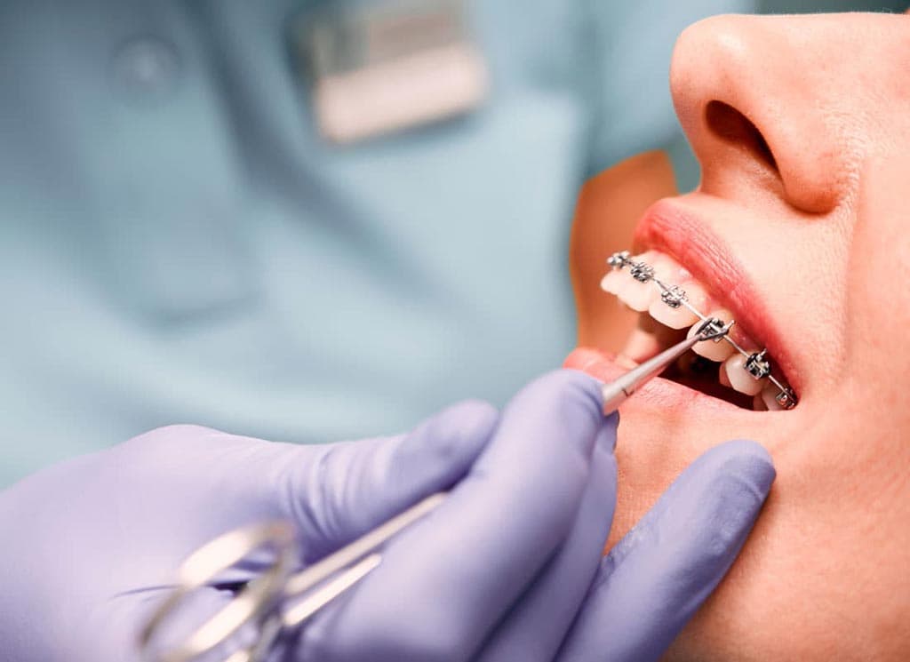 ¿Qué son los brackets de autoligado?