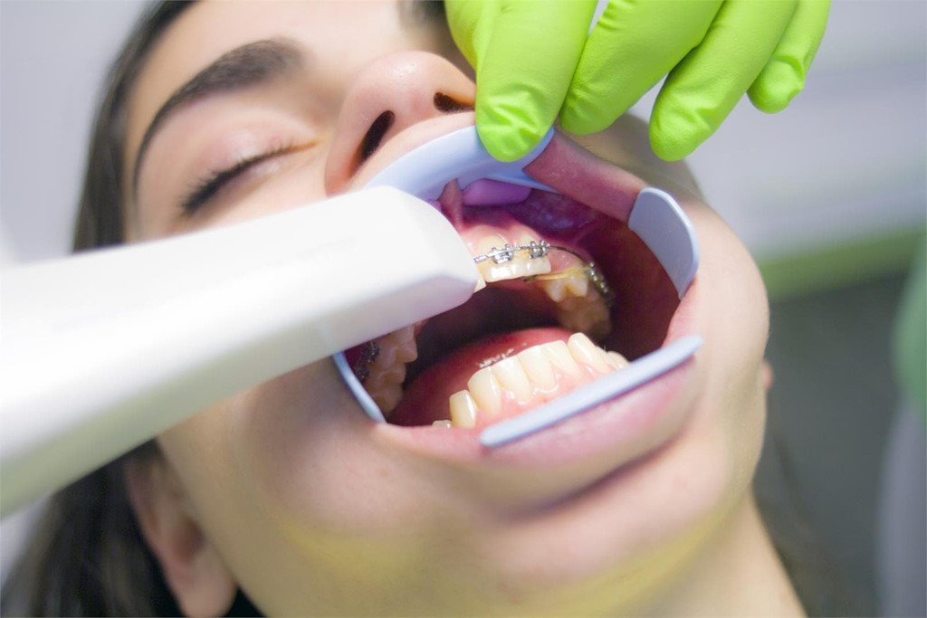 Las consecuencias de una mala higiene dental durante el tratamiento de ortodoncia