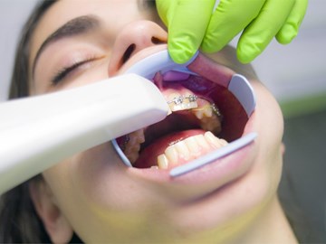 Las consecuencias de una mala higiene dental durante el tratamiento de ortodoncia