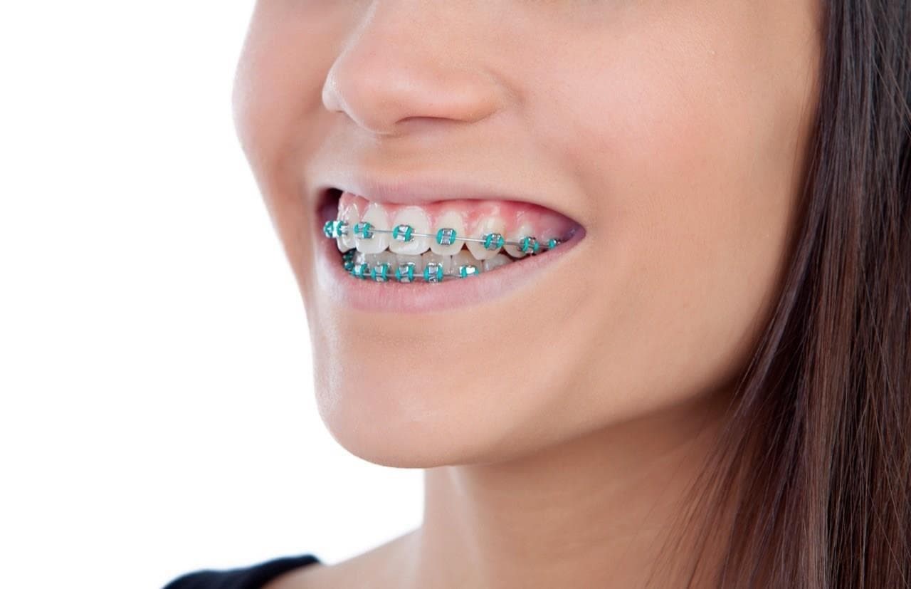 ¡Los brackets tradicionales nunca pasan de moda! - Imagen 1