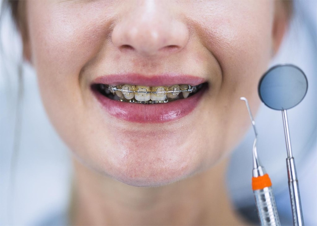 Mitos y curiosidades sobre la ortodoncia