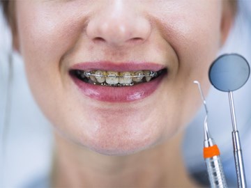 Mitos y curiosidades sobre la ortodoncia