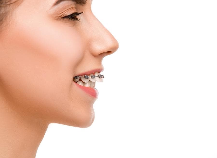 ¿Para qué sirven los brackets de autoligado? - Imagen 1