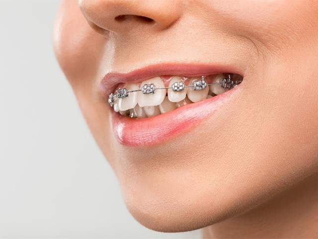 ¿Por qué optar por brackets estéticos?