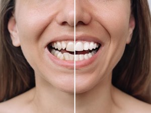 ¿Qué aparato dental es el más efectivo?