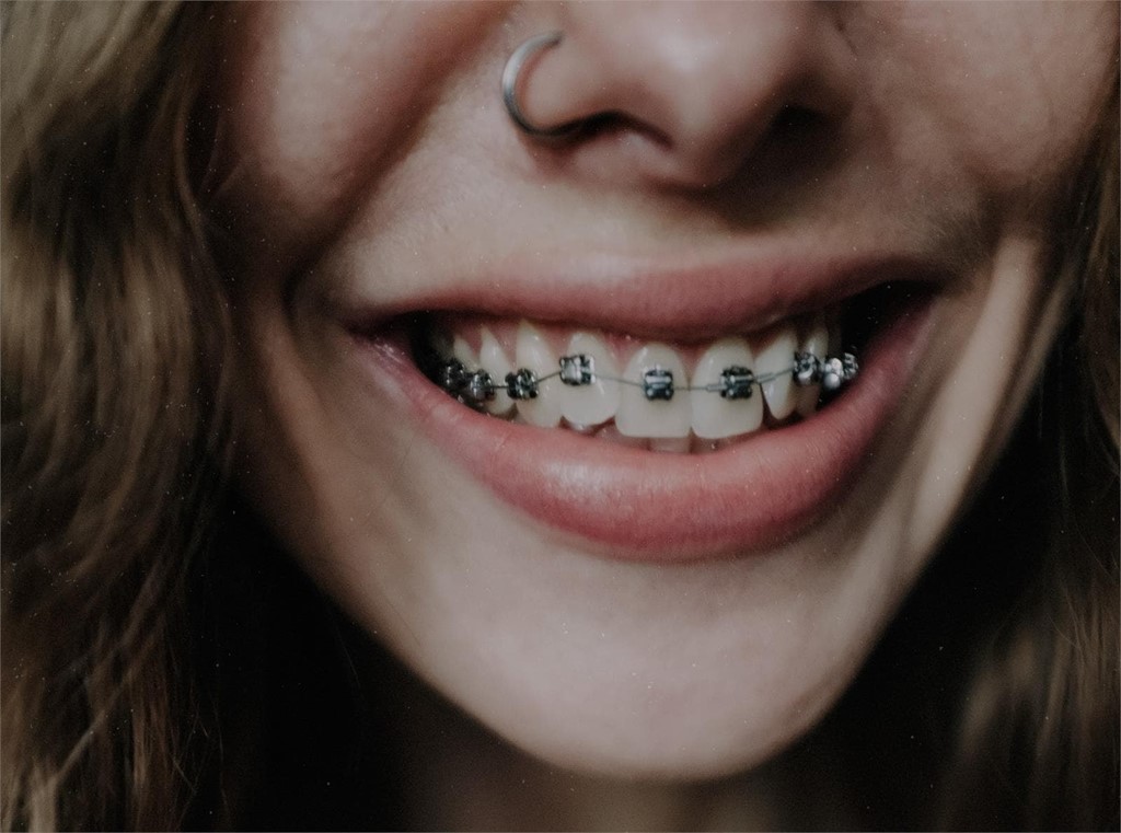 ¿Qué color de gomas de brackets es el más escogido?