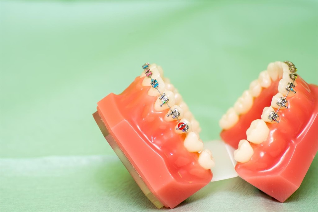 ¿Qué diferencias hay entre los brackets metálicos y los brackets estéticos?