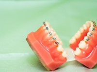 ¿Qué diferencias hay entre los brackets metálicos y los brackets estéticos?