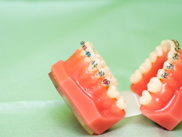 ¿Qué diferencias hay entre los brackets metálicos y los brackets estéticos?
