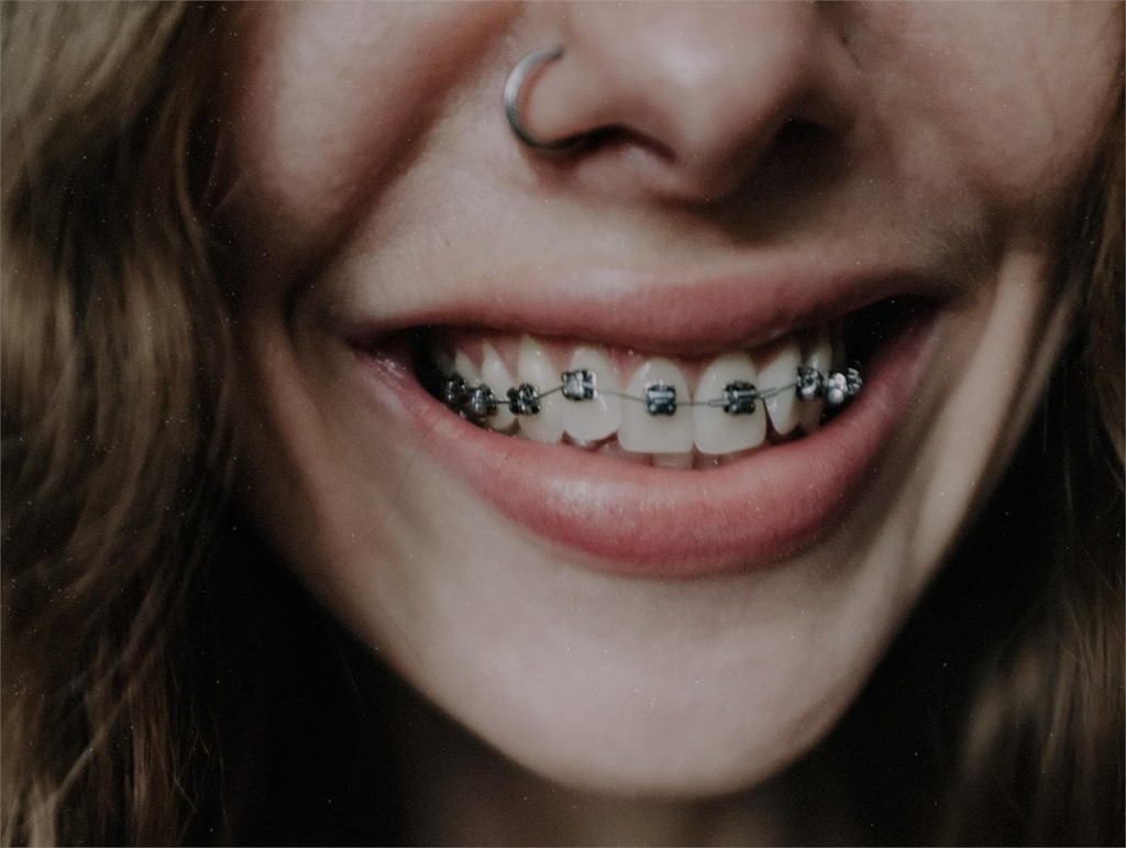 ¿Qué duración tiene un tratamiento de ortodoncia con brackets?