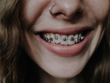 ¿Qué duración tiene un tratamiento de ortodoncia con brackets?