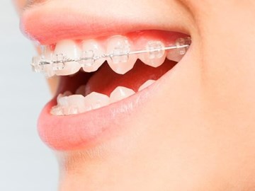 ¿Qué duración tiene un tratamiento de ortodoncia?