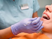 ¿Qué son los brackets de autoligado y en qué se diferencian de los tradicionales?