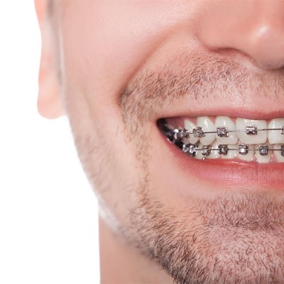 ¿Se puede comer de todo usando aparato dental?