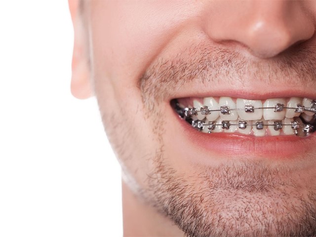 ¿Se puede comer de todo usando aparato dental?