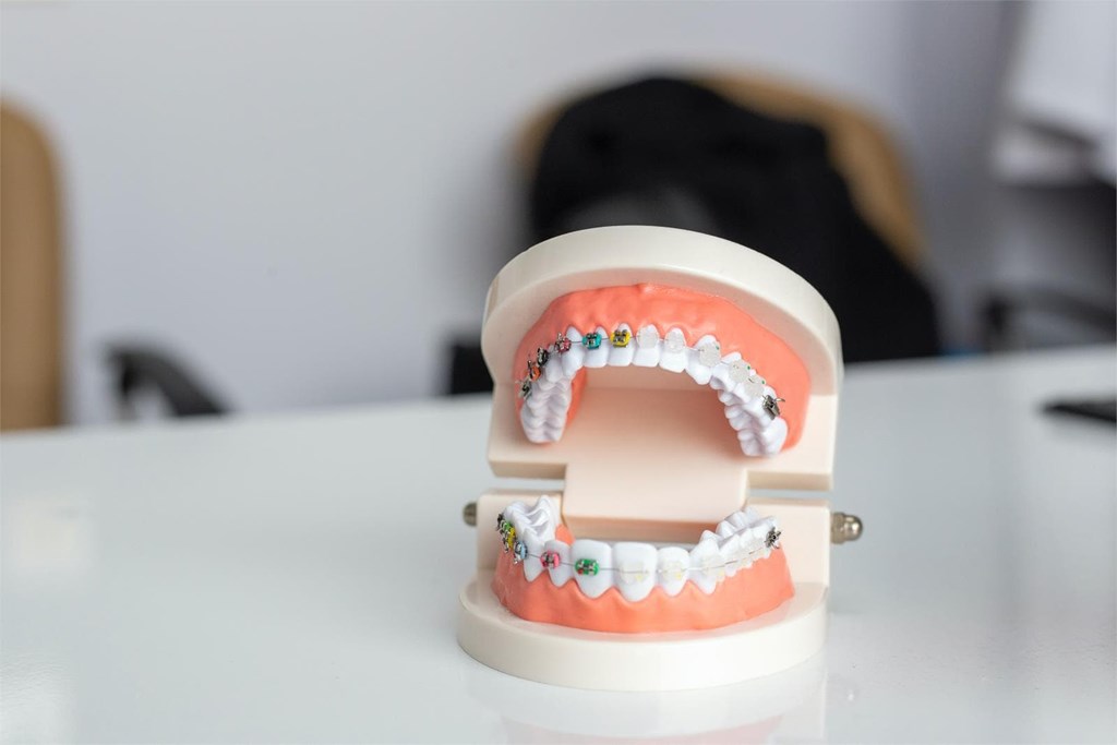 ¿Se pueden colocar brackets únicamente dos o tres piezas dentales?