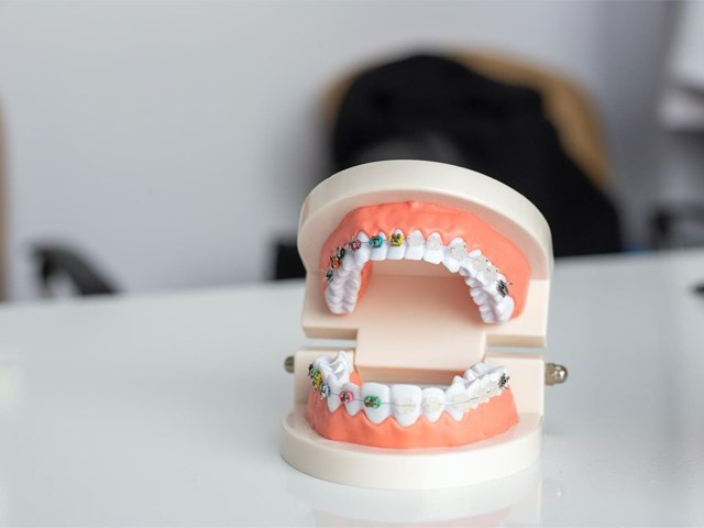 ¿Se pueden colocar brackets únicamente dos o tres piezas dentales?