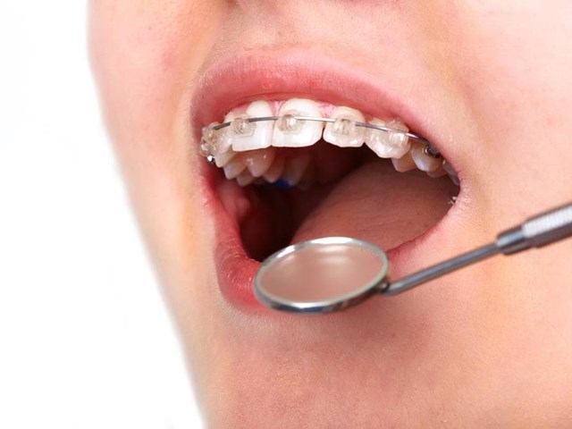 Tipos de ortodoncia: ¿cuál es la mejor para mi caso?